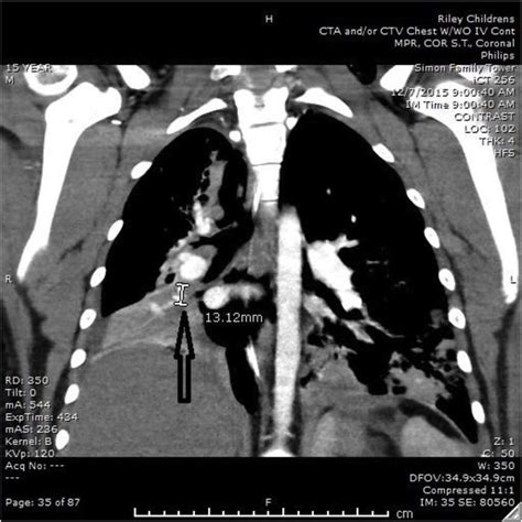 CT chest showing calcified granuloma in the right lung. | Download ...