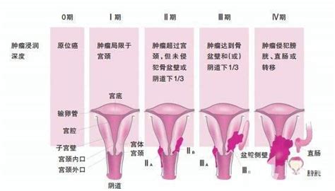 宮頸癌的早期信號和預防方法，女人你知道多少？ 每日頭條