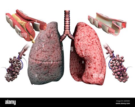 Chronic Obstructive Pulmonary Disease Illustration Showing The Lungs