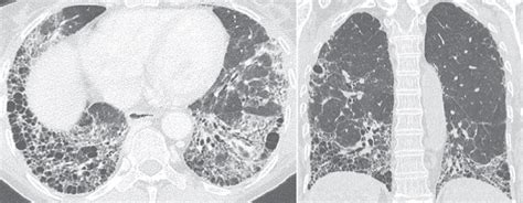 Uip Pattern In A 57 Y O Female Patient With Anti Synthetase Syndrome Download Scientific