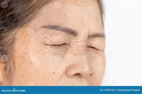 The Wrinkle And Freckles Blemish And Flabby Skin Dark Spots And