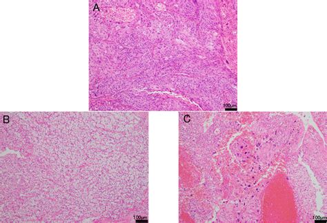 A The Left Lung Squamous Cell Carcinoma Scc Specimen Obtained After