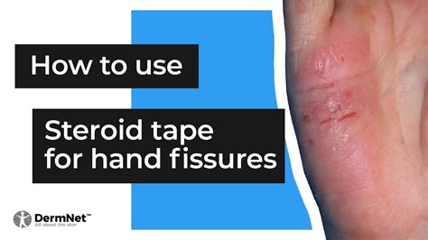 How To Use Steroid Tape For Hand Fissures Youtube