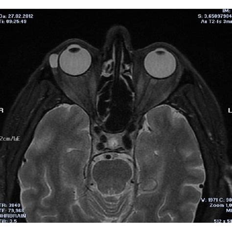 Magnetic resonance image of dacryops. | Download Scientific Diagram