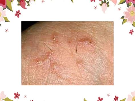 Scabies Pptx