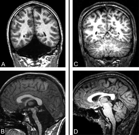 Cerebellar stroke - it's about more than coordination and balance - The Stroke Blog