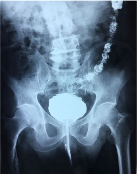 Figure 1 from Entero-vesical fistula revealed by recurrent urinary ...