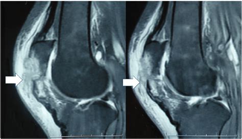 Mri Of A Patient With Avulsion Of The Patellar Tendon From The Patella