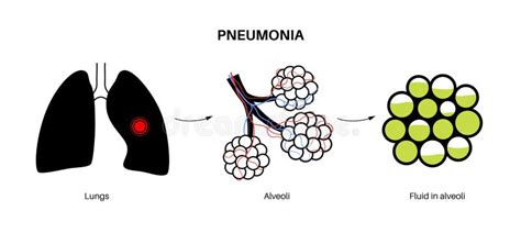 P Ster De Infecci N Por Neumon A Ilustraci N Del Vector Ilustraci N