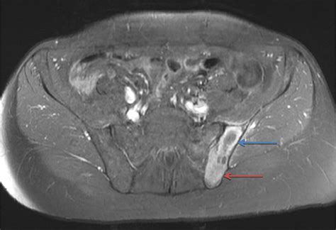 Axial T1 Weighted Fat Saturated Postcontrast MRI Image Demonstrates