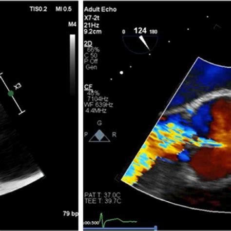 Transesophageal Echocardiogram Findings Consistent With Severe Aortic