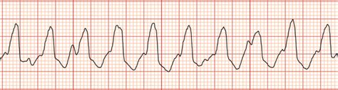 Ventricular Rhythms Jeopardy Template