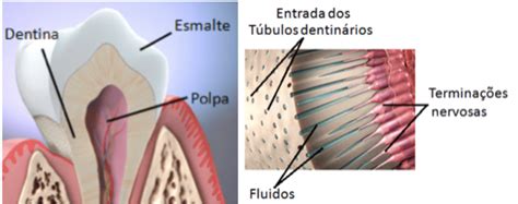 Sensibilidade Nos Dentes Veja Os Principais Motivos Md Odontologia