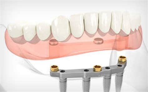 Bar retained overdenture - Dentist in Deux-Montagnes