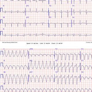 Twelve Lead Electrocardiograms A A 12 Lead Electrocardiogram ECG