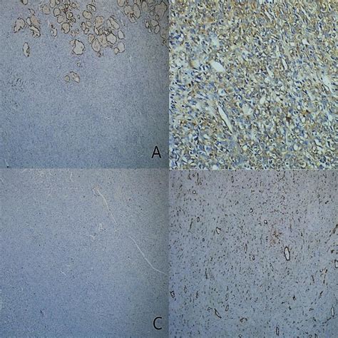 Immunohistochemical Profile Of Thyroid Sft Total Negativity For A