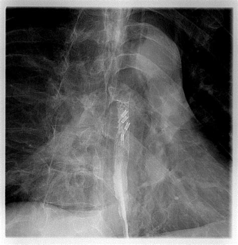 Esophageal Perforation And Its Treatment Image Radiopaedia Org