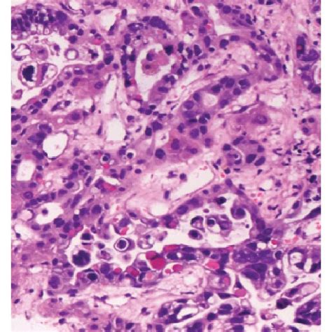 A Gastric Adenocarcinoma Papillary Growth Pattern B Gastric Tumor Download Scientific