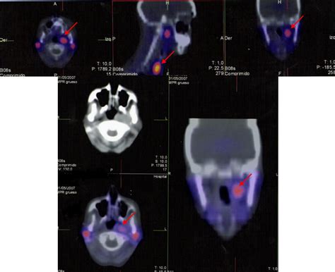 Coexistence of a pituitary macroadenoma and multicentric paraganglioma