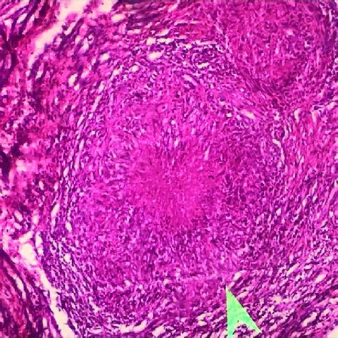 Histopathology Slide Of Synovial Tissue Revealing Multiple Granulomas Download Scientific