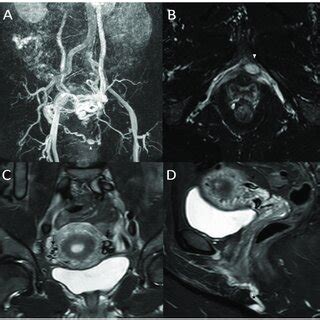 A 38 Year Old Woman Who Suffered From Recurrent Varicose Veins In The