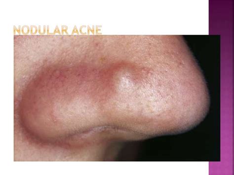 Treatment Of Acne Vulgaris In General Practice Ppt