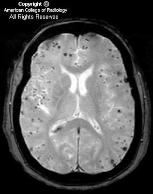 Cerebral Amyloid Angiopathy MRI