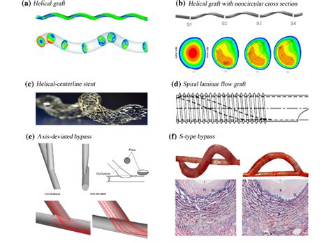 Potential Clinical Applications Of The Helical Flow Mechanism In