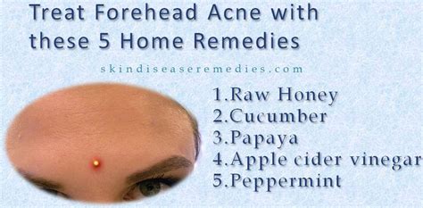 5 Effective Home Remedies for Forehead Acne - Skin Disease Remedies