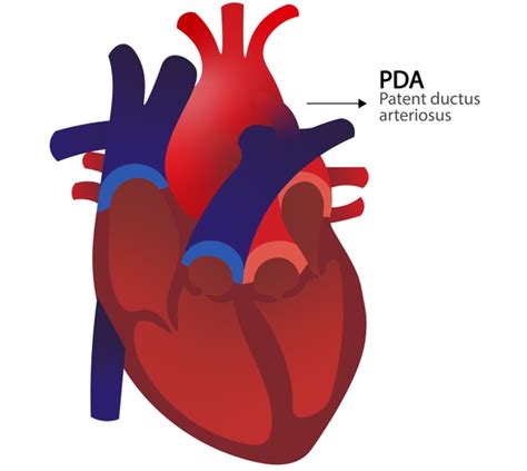 Patent Ductus Arteriosus Pda In Newborn Infants