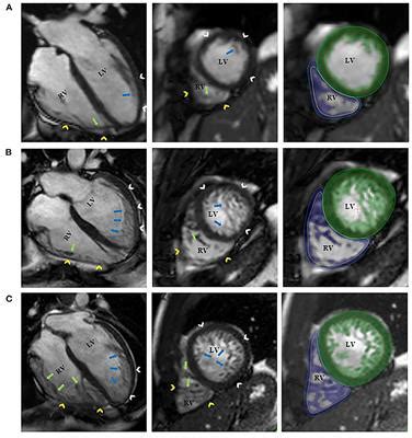 Frontiers Impact Of Right Ventricular Trabeculation On Right