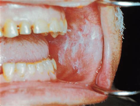 White Oral Lesions How To Distinguish The Benign From The Deadly