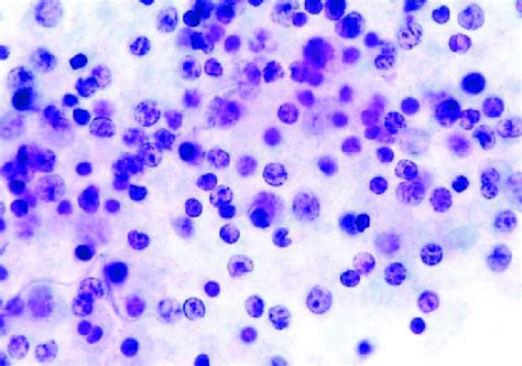 Common Cells In Peritoneal Fluid