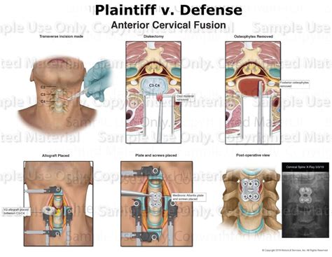 Anterior Cervical Diskectomy Fusion Motionlit