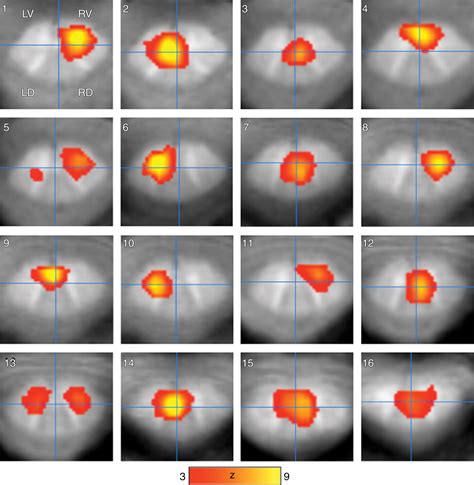 Intrinsic Resting State Functional Connectivity In The Human Spinal