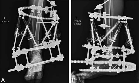 Anteroposterior A And Lateral B Radiographs Demonstrate Application Download Scientific