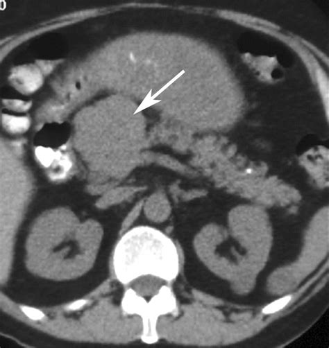 Multi Detector Row Ct Of Pancreatic Islet Cell Tumors Radiographics