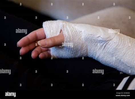 A Broken Right Arm Colles Fracture Set In Plaster From The Hand To Just