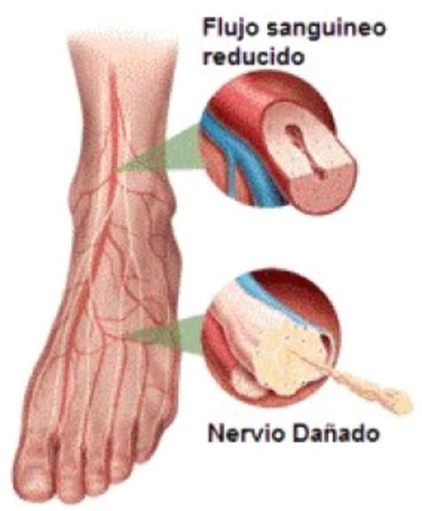 Qu Es La Neuropatia Diab Tica