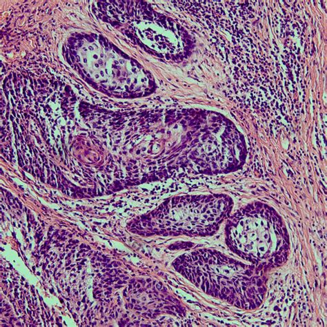 Light Microscopy Revealed An Invasive Basaloid Squamous Cell Carcinoma