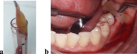 A And B Production Of Concentrated Growth Factor Cgf Following Blood