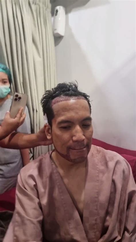 7 Potret Desta Jalani Transplantasi Rambut Dan Jenggot Jambang Mulai