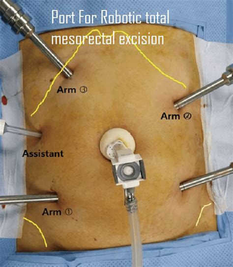 Port Position Of Various Robotic General Surgeries