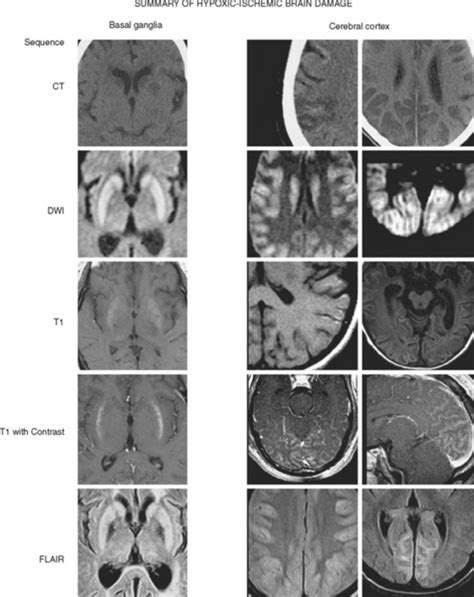 Hypoxic-Ischemic Brain Damage | Clinical Gate