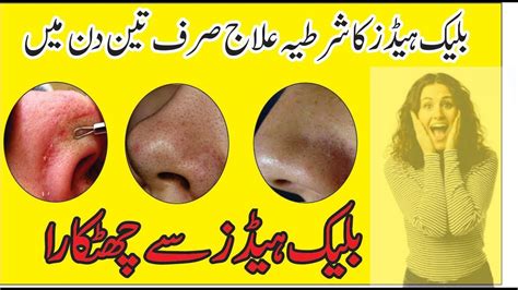 BLACKHEAD REMOVAL Mask In Urdu Blackheads Khatam Karne Ka Tarika YouTube