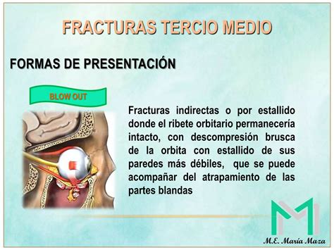 Fracturas Faciales Tercio Superior Y Medio Ppt