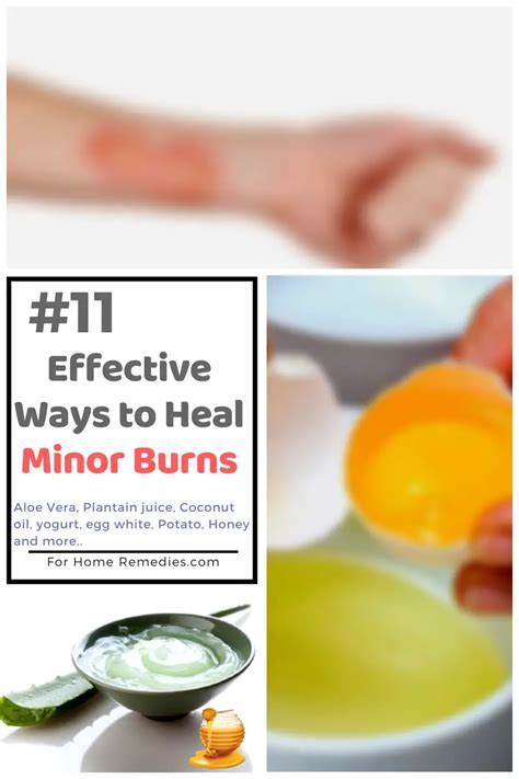 11 Quick Soothing Home Remedies for Minor Burns { Effective Ways }