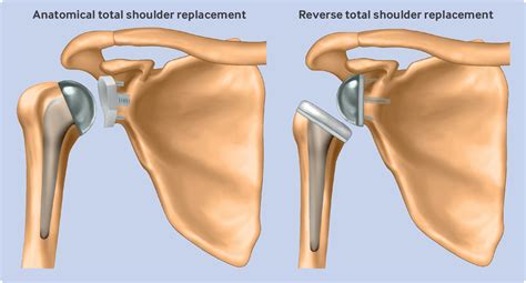 Reverse Total Shoulder Replacement Versus Anatomical Total Shoulder Replacement For