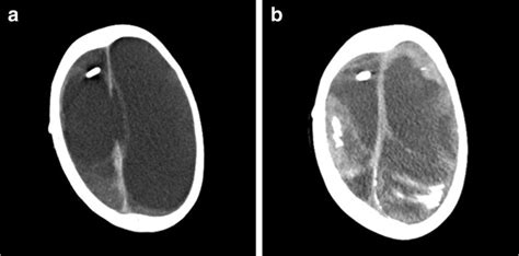 Case 2 A Ct Demonstrating Hydranencephaly B Ct Demonstrating Multiple