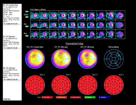 Radionuclide Imaging of the Heart - Cardiovascular Disorders - MSD ...